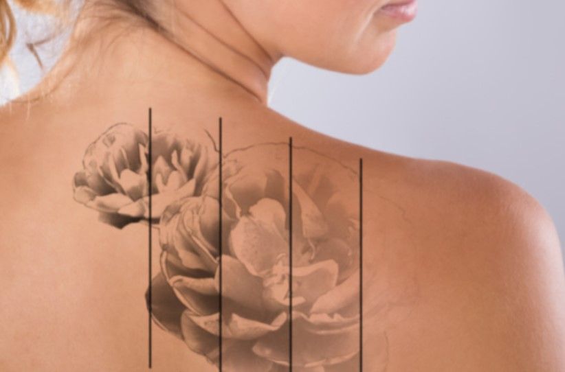 The Tattoo Removal Clinic showing stages of tattoo fading on a back