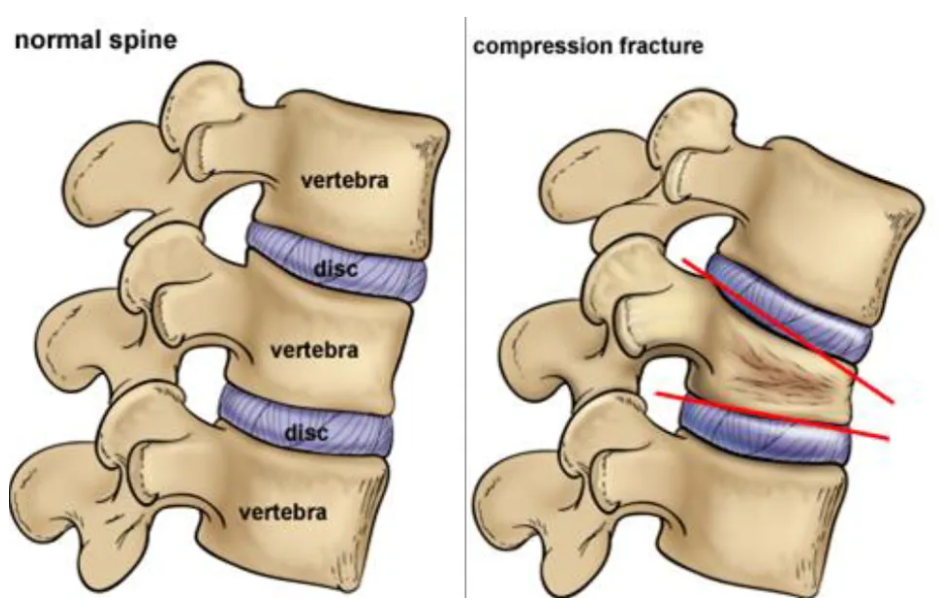 Side views of a normal spine and a spine with a compression fracture. An osteoporotic compression  fracture causes the front of the vertebral body to collapse in a wedge-shape.