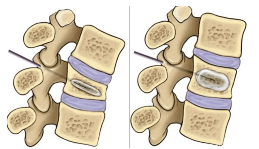 Figure 3. The balloon is inserted into the working channel inside the vertebra, then inflated to raise the vertebra to the appropriate height.