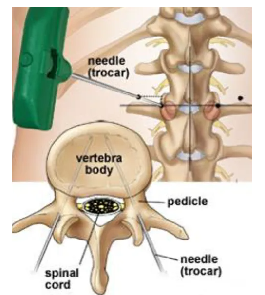 Using fluoroscopy tool