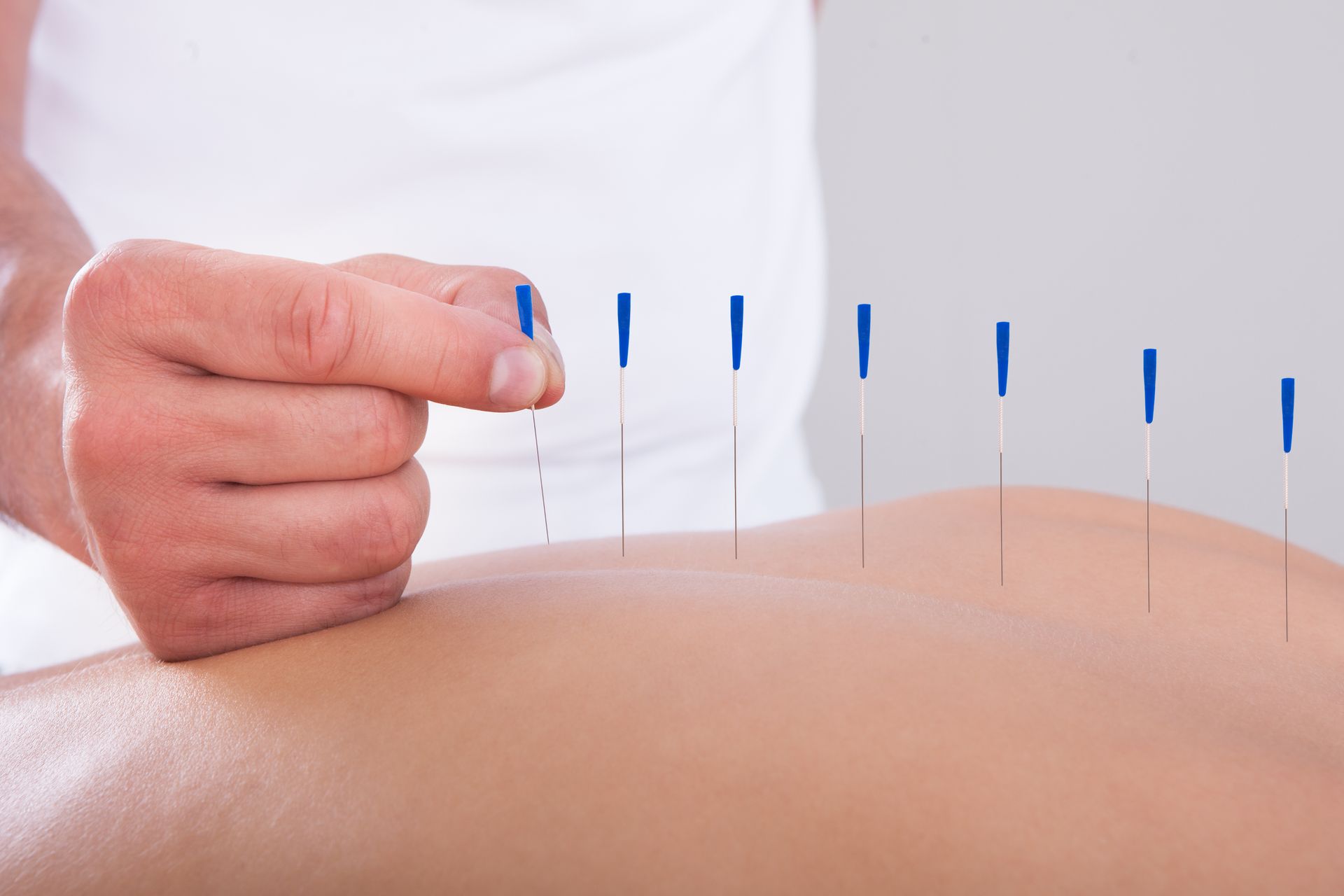 A person is getting acupuncture on their back.