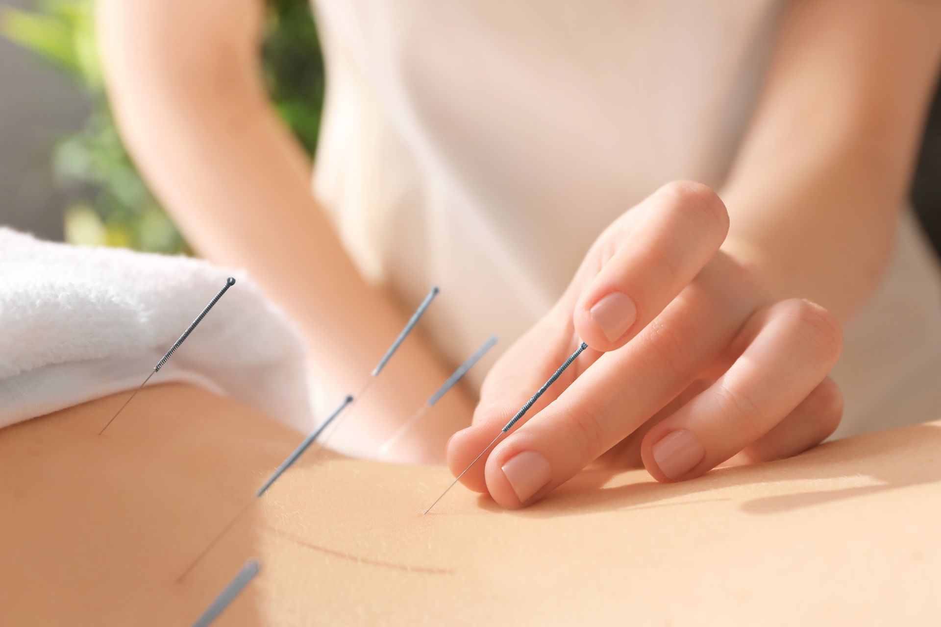 A person is getting acupuncture on their back.