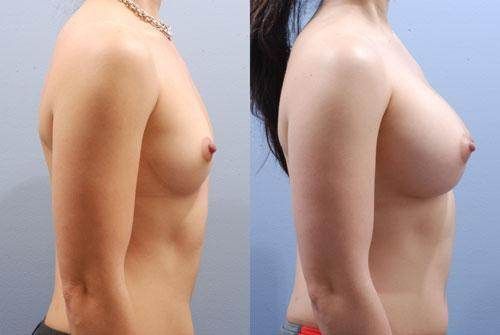 Breast Augmentation Before and After Pictures