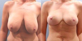 Breast Lift Before and After Pictures