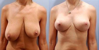 Breast Augmentation with Lift Before and After Photos