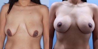 Breast Augmentation with Lift Before and After Pictures