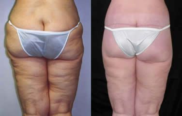 Lower Body Lift Before and After Pictures