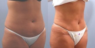 Lower Body Lift Before and After Pictures