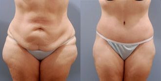 Lower Body Lift Before and After Pictures