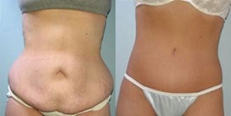 Lower Body Lift Before and After Pictures