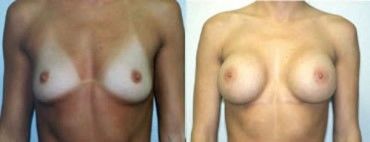 Breast Augmentation Before and After Pictures
