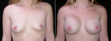 Breast Augmentation Before and After Pictures