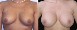Breast Augmentation Before and After Pictures