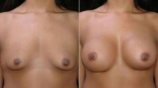 Breast Augmentation Before and After Pictures
