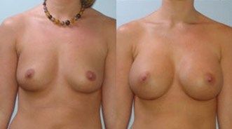 Breast Augmentation Before and After Pictures