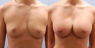 Breast Augmentation Before and After Pictures