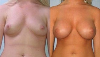 Breast Augmentation Before and After Pictures