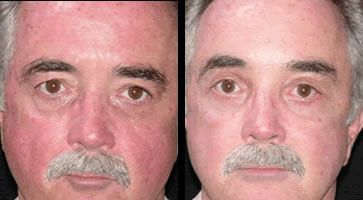 Browlift Before and After Pictures