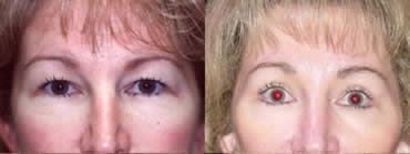 Eyelid Lift Before and After Pictures