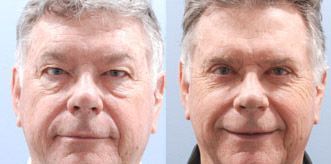 Eyelid Lift Before and After Pictures