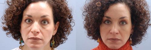 Eyelid Lift Before and After Pictures