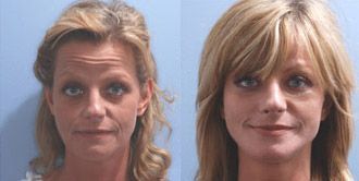 Facelift Before and After Pictures