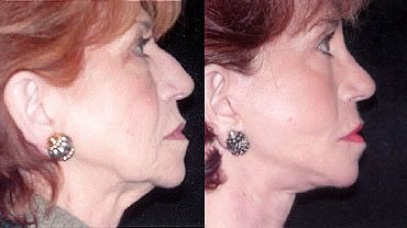 Facelift Before and After Pictures