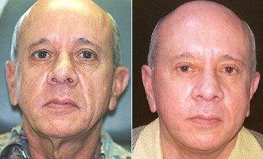 Facelift Before and After Pictures