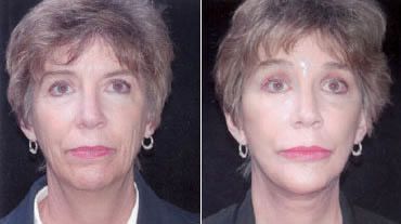 Facelift Before and After Pictures