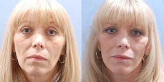 Facelift Before and After Pictures