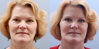 Facelift Before and After Pictures
