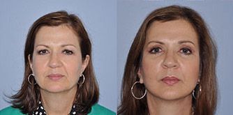 Facelift Before and After Pictures