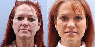 Facelift Before and After Pictures