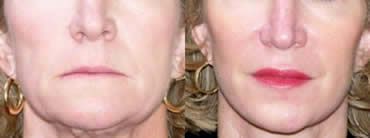 Fat Injection Before and After Pictures