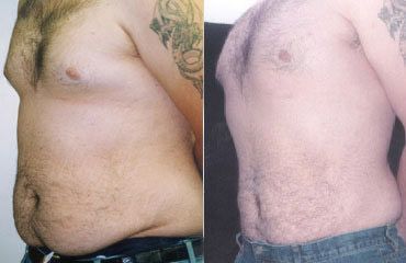 Liposuction Before and After Pictures