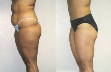 Liposuction Before and After Pictures