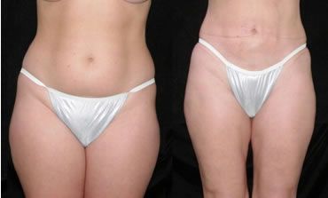 Liposuction Before and After Pictures