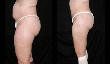 Liposuction Before and After Pictures