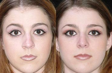 Rhinoplasty Before and After Pictures