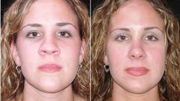 Rhinoplasty Before and After Pictures