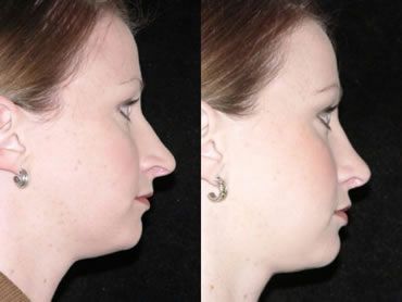 Rhinoplasty Before and After Pictures