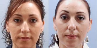 Rhinoplasty Before and After Pictures
