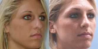 Rhinoplasty Before and After Pictures