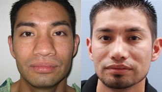 Rhinoplasty Before and After Pictures
