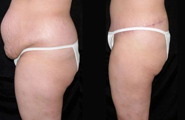 Tummy Tuck Before and After Pictures