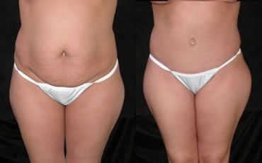 Tummy Tuck Before and After Pictures