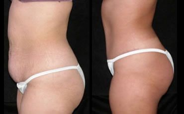 Tummy Tuck Before and After Pictures
