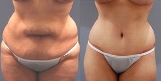 Tummy Tuck Before and After Pictures