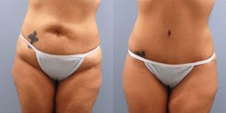 Tummy Tuck Before and After Pictures