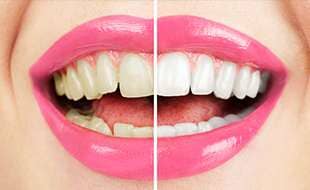 Healthy woman white teeth - Dental Care in San Bernardino, CA